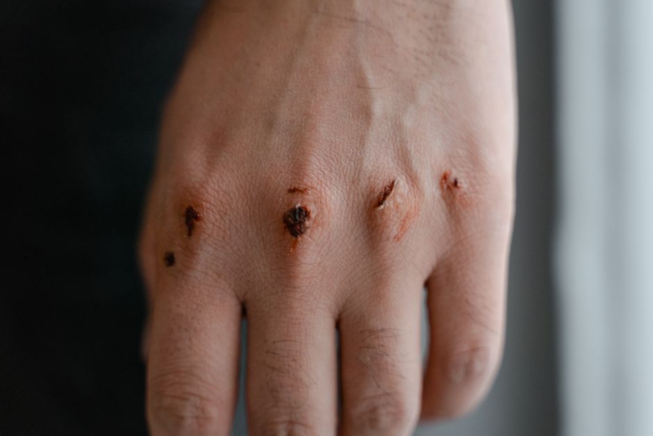 Imagem de uma mão com cortes e feridas, sugerindo cuidados ou problemas de saúde relacionados à pele ou às mãos.