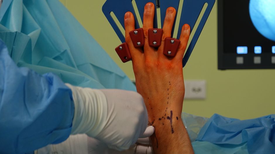 Imagem de uma mão de paciente sendo submetida a um procedimento cirúrgico, com sinais de marcações pré-operatórias e equipe médica ao fundo, simbolizando avanços na medicina e procedimentos cirúrgicos.