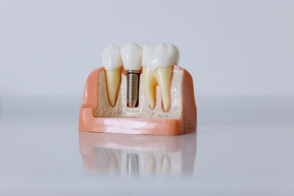 Modelo de implante dentário mostrando estrutura de um dente artificial inserido na gengiva artificial, ilustrando procedimentos odontológicos avançados.