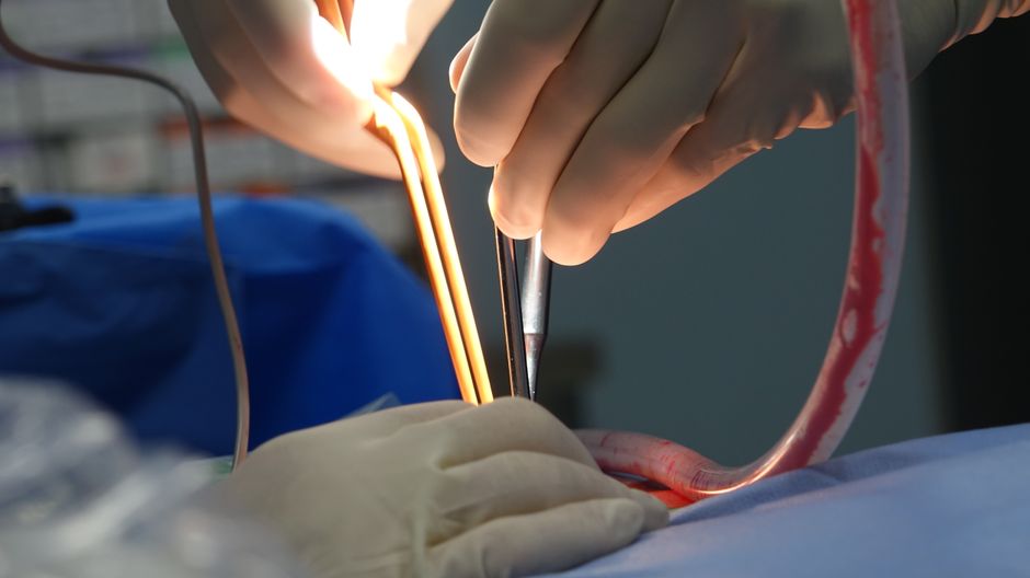 Imagem de uma cirurgia sendo realizada, com destaque para as mãos do cirurgião manipulando instrumentos médicos em um procedimento invasivo